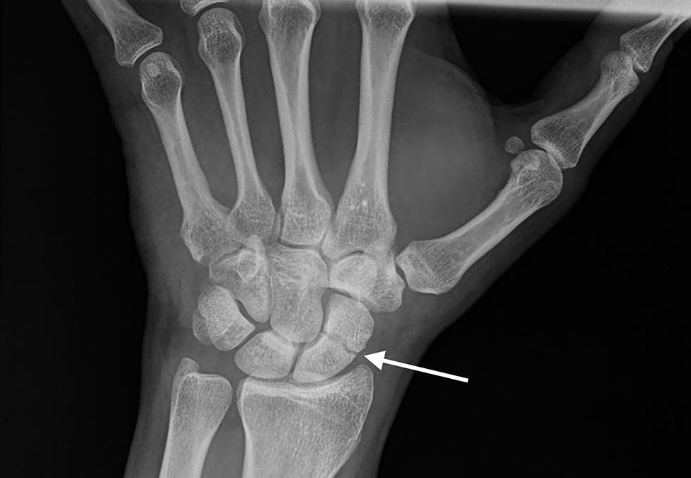 The Scaphoid Fracture