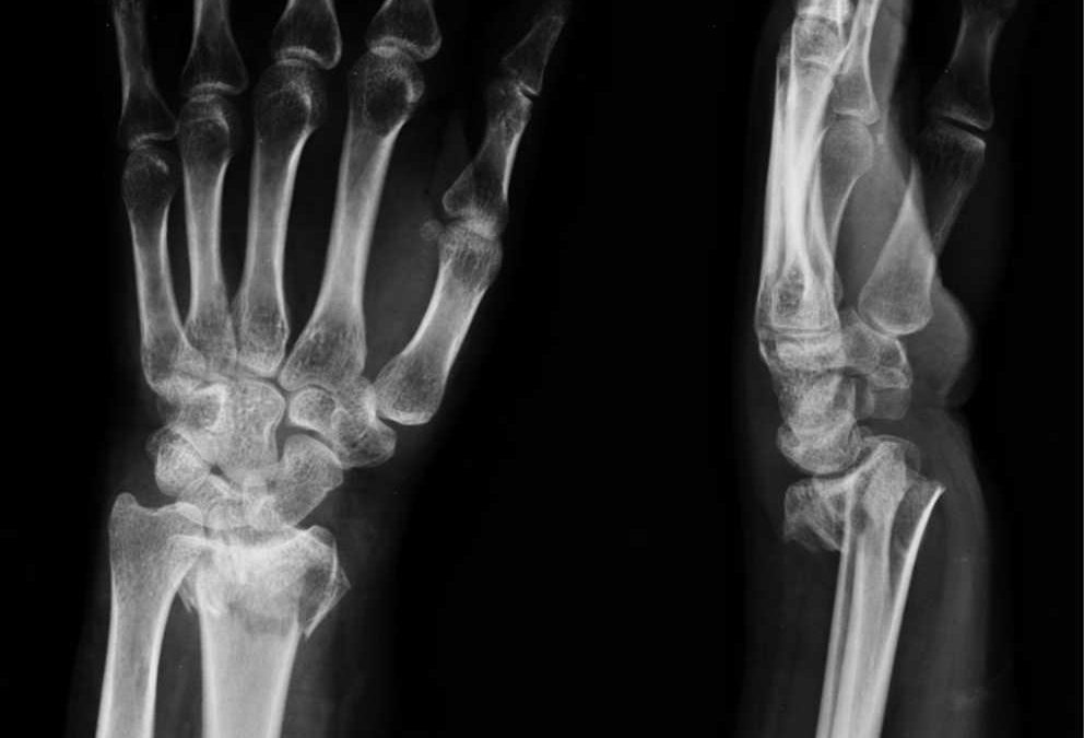 Radius Fracture (distal radius fracture)