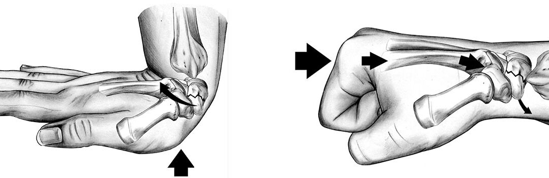 Did I fracture the scaphoid on my wrist?